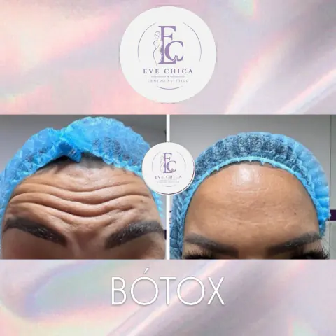 Antes y después de botox en la frente
