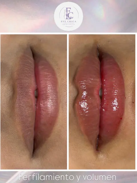 Antes y después de perfilamiento y volumen de labios