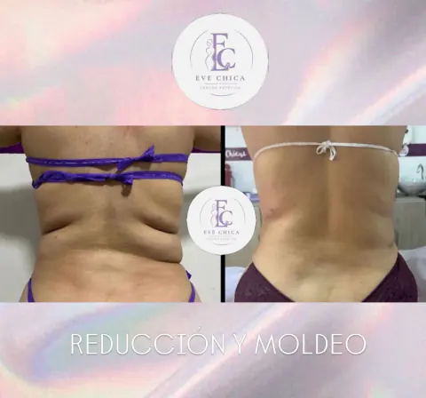 Antes y después de reducción y moldeo de cintura