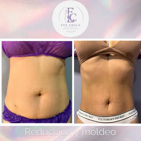 Antes y después de reducción y moldeo de abdomen