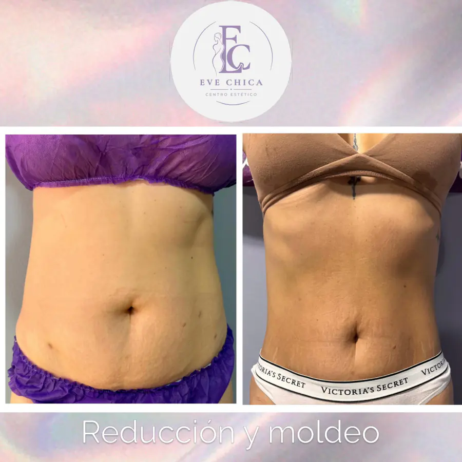 Antes y después de un tratamiento de reducción y moldeo de abdomen